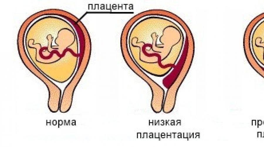 Низкая плацентация при беременности: причины, симптомы и лечение