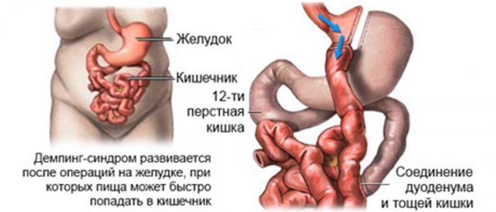 Демпінг це: Неприпустима назва — Вікіпедія