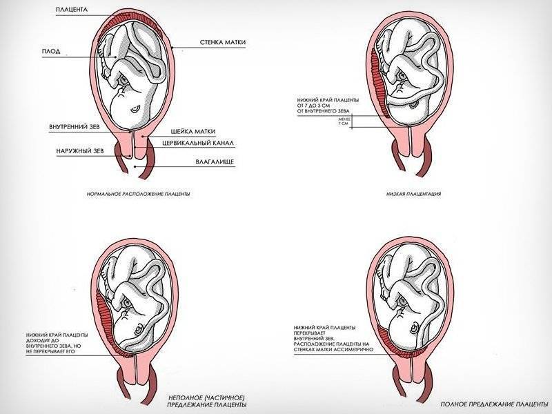 Низкая плацентация при беременности: причины, симптомы и лечение
